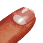 Onicolisis