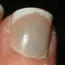 Sindrome de las uñas verdes