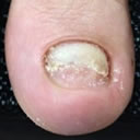 Engrosamiento ungueal