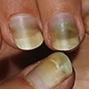 Pseudomona aeruginosa